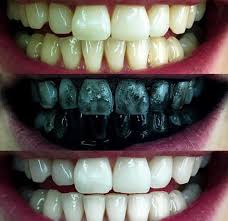 activated charcoal for teeth whitening